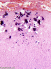 Sturge Weber disease, H&E stain, low-power