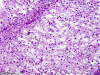 Tumefactive demyelination, frozen section preparation, H&E stain x 100