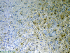 Tumefactive demyelination, immunohistochemical staining for GFAP x 100