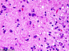 Tumefactive demyelination, H&E stained slide x 200