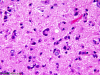 Tumefactive demyelination, H&E stain slide x 200