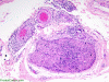 T cell lymphoma involving sural nerve, H&E stain x 40