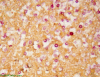 Cryptococcoma, mucicarmine staining, high power