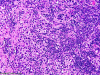 Pineal region germinoma, H&E stain x 200