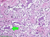 Rosetted Glioneuronal Tumor IVth Ventricle H&E with arrow