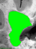 Well-demarcated MS Plaque - Highlighted