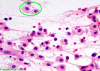 Tumefactive demyelination, intraoperative crush preparation with circled cells