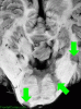 Multiple sclerosis, transverse section through pons and cerebellum with arrows