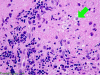 Optic Neuritis, H&E stain x400 with arrow