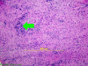 Optic Neuritis, H&E stain x100 with arrow