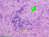 Optic Neuritis, H&E stain x200 with arrow