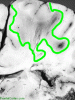 Acute necrotizing hemorrhagic leukoencephalitis, outlined