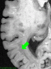 Adrenoleukodystrophy, horizontal section with arrow