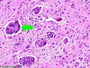 Krabbe disease, H&E stain x 100 with arrow