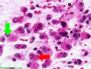 Atypical teratoid/rhabdoid tumor, intraoperative smear preparation x 400 (H&E stain) with arrows