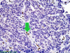 Atypical teratoid/rhabdoid tumor, BAF-47 immunohistochemical staining with arrow