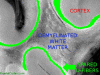 Pelizaeus Merzbacher disease, Coronal section, Close Up, labeled