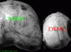 Optic Glioma Gross, Labeled