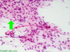 Glioblastoma multiforme, intraoperative smear preparation of drop metastasis, H&E x 100 with arrow