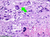 Monstrocellular Glioblastoma with arrow