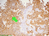 Glioblastoma multiforme, spinal metastasis, GFAP immunohistochemical staining. with arrow