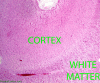 Alexander Disease, cerebral cortex and white matter, H&E stained section, 20X magnification, labeled