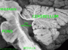 Posterior Fossa Sagittal, Labeled