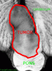 Brainstem Ependymoma, transverse section through brainstem, labeled