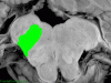 Dorsolateral Medullary Infarct, transverse section, shaded