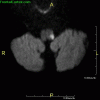 Wallenberg Syndrome MRI