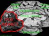 Posterior cerebral artery infarct, mid sagittal section of cerebral hemisphere, Labeled