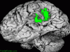 Cavitated MCA infarct, lateral surface of brain, labeled