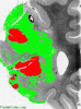 Recent middle cerebral artery infarct, whole mount coronal section through frontal lobe, labeled