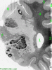 Recent middle cerebral artery infarct, whole mount coronal section through frontal lobe, anatomical landmarks