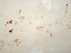 Type 2 prion disease, immunohistochemical stains sectioned from hippocampus.