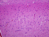 Type I prion disease, hippocampus, H&E stained section x 100