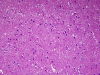 Type 2 prion disease, H&E stained section of hippocampus.