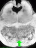 Central Pontine Myelinolysis, transverse section with arrow