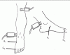 Tibial Motor Nerve - recording the Abductor Hallucis