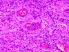 Anaplastic ependymoma, microvascular proliferation.