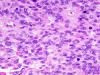 Anaplastic ependymoma, H&E x 400