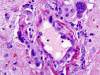 Amyloid beta related angiitis, H. and E. stain x 400