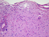  Amyloid beta related angiitis, H&E stained x 100