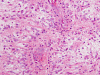 Pilomyxoid astrocytoma, H&E stain x 200