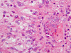 Pilomyxoid astrocytoma, H&E stain x 400