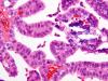 Choroid plexus papilloma, H&E stain x 400