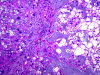 Chordoma (clivus), H&E stain x 100