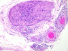 Leukemic infiltration of peripheral nerve