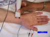 Median Sensory Nerve Conduction Study - Recording the thumb (antidromic)