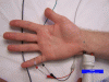 Ulnar Sensory Nerve Conduction Study (antidromic)